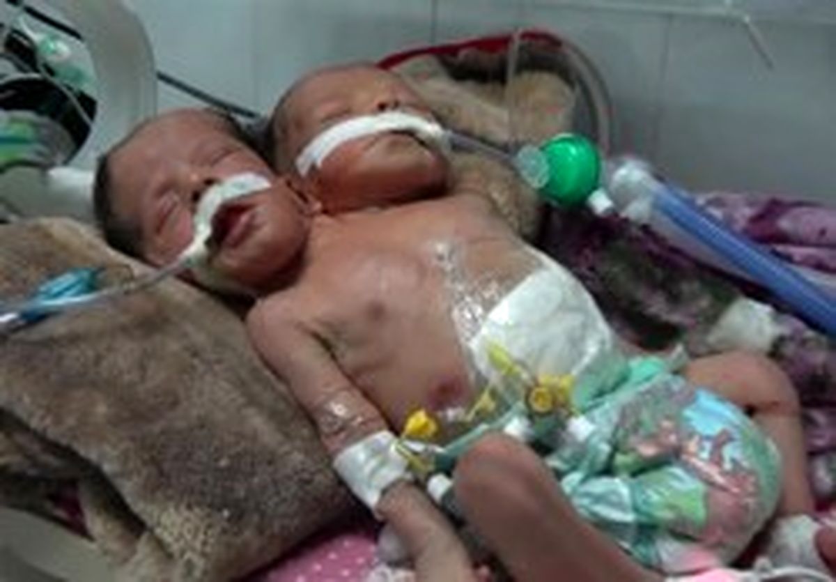 جان باختن دوقلو‌های به هم چسبیده یمنی به‌دلیل کارشکنی عربستان